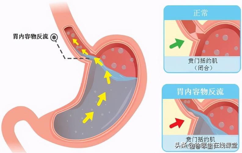 怎样预防胆汁反流性胃炎-