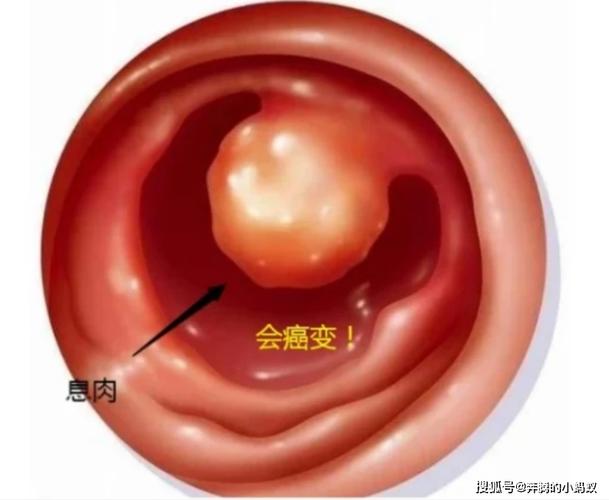 腹胀的症状有哪些表现呢？