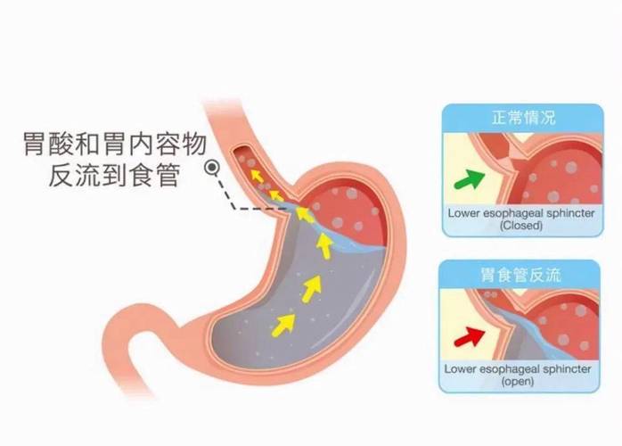 直肠炎患者病发时要注意些什么呢？