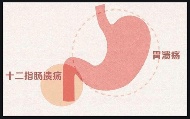 直肠炎的种类危害