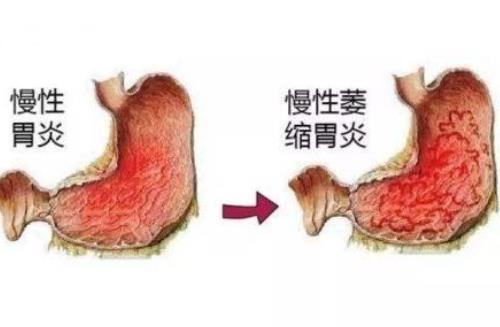 直肠炎的几种病因