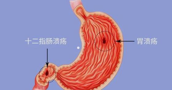 直肠炎会带来哪些的危害