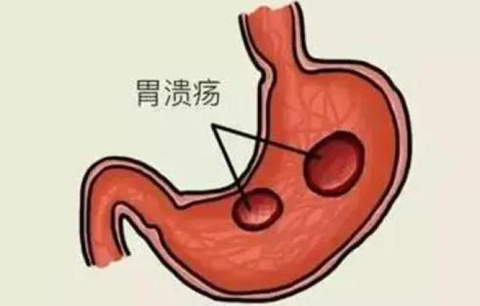 治疗慢性胃炎哪种方法好