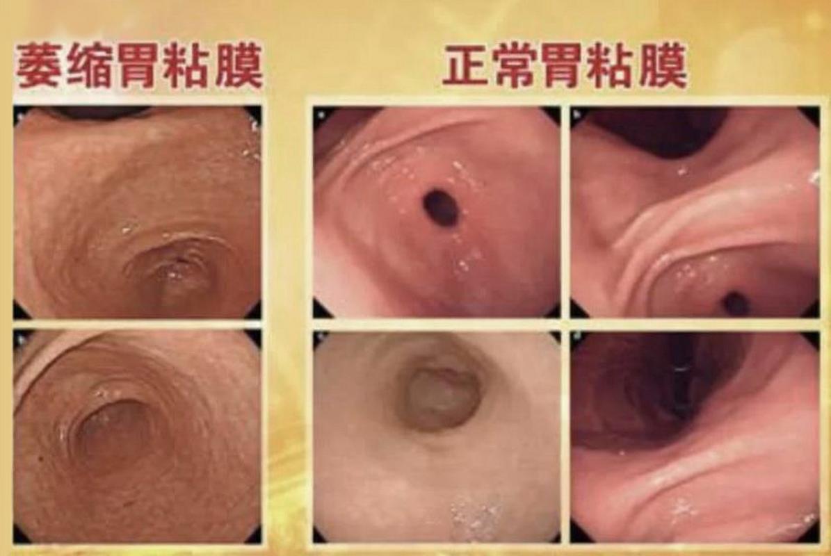 肠胃息肉是什么引起的