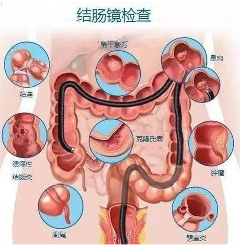 治疗胃溃疡的中药