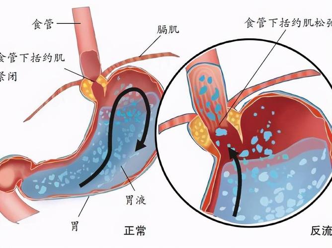 直肠炎是由哪些因素造成的？