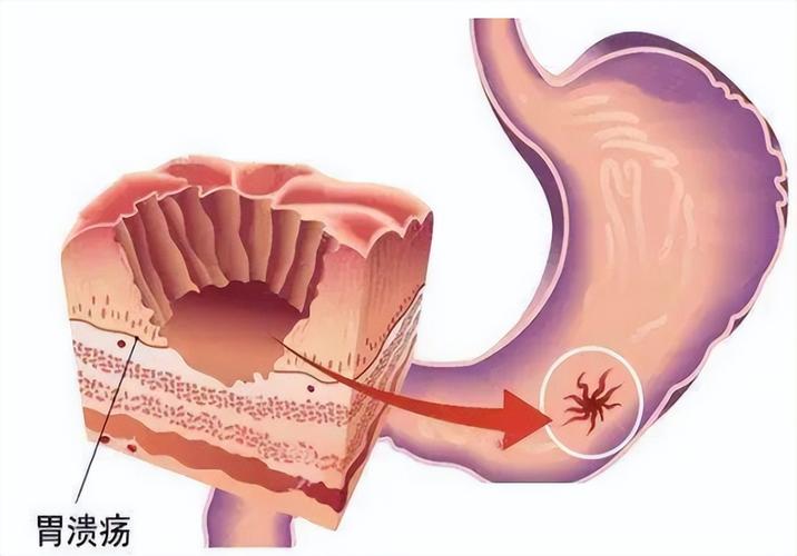 预防浅表性胃炎复发的方法